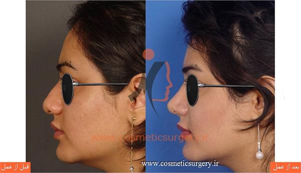 عمل جراحی بینی گوشتی