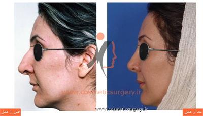 جراحی زیبایی بینی