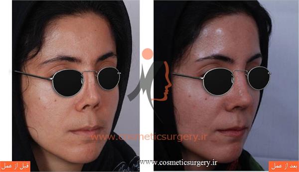 ترمیم بینی در بیماری که قبلا توسط جراحان دیگری عمل شده است