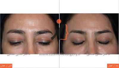 جراحی پلک لیفت ابرو