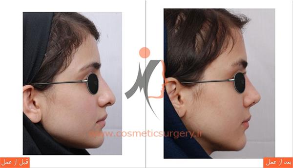جراحی زیبایی بینی 1