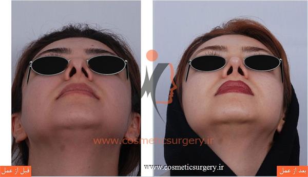 ترمیم بینی در بیماری که قبلا توسط جراحان دیگری عمل شده است