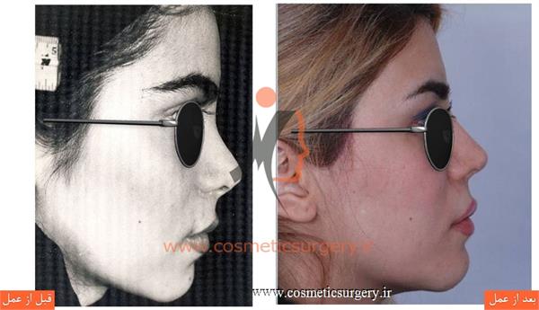 ترمیم بینی در بیماری که قبلا توسط جراحان دیگری عمل شده است