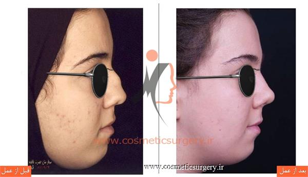 عمل جراحی انحراف بینی