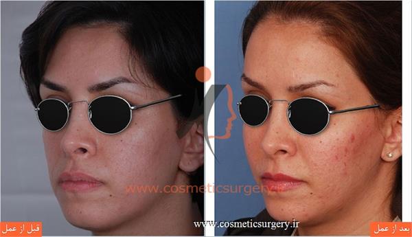 تزریق چربی صورت و گونه