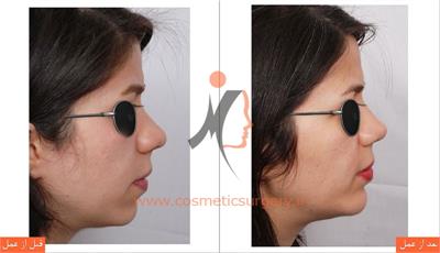 جراحی چانه 1