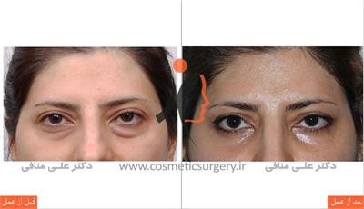 Eyelid surgery 2