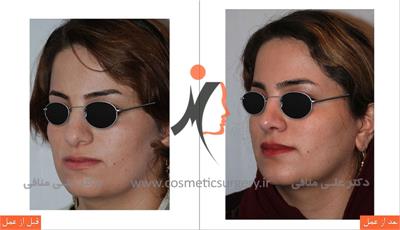 عمل جراحی زیبایی بینی 2