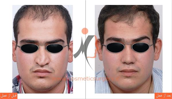 جراحی زیبایی بینی 2