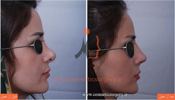 ترمیم بینی در بیماری که قبلا توسط جراحان دیگری عمل شده است