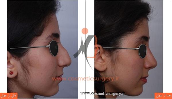 عمل جراحی بینی گوشتی