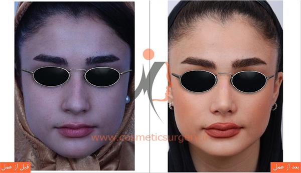 جراحی زیبایی بینی