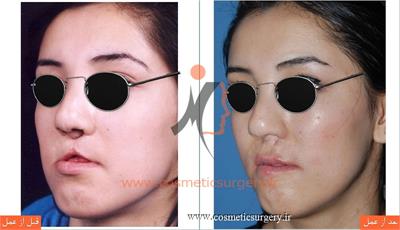 جراحی و ترمیم شکاف لب و کام