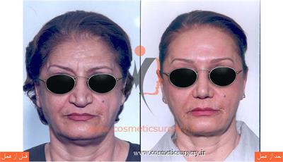 جراحی زیبایی بینی به همراه تزریق چربی و کشیدن پیشانی