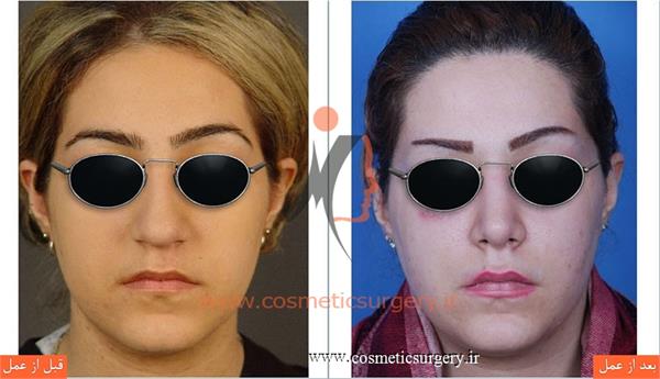 جراحی زیبایی بینی