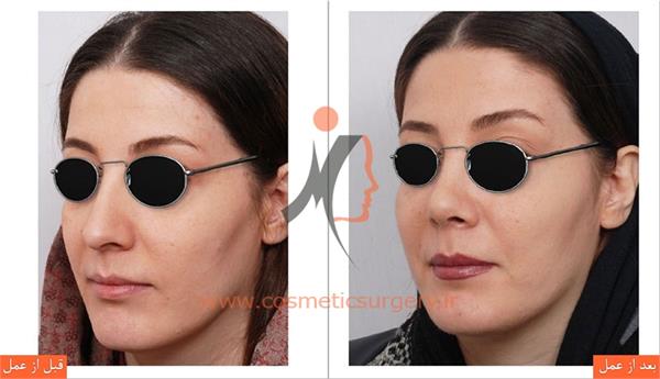 جراحی زیبایی بینی و تزریق چربی 2