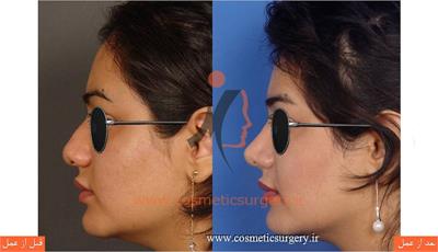 عمل جراحی بینی گوشتی