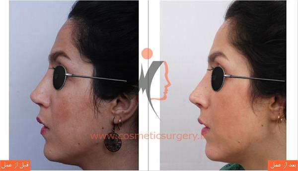 ترمیم بینی عمل شده توسط جراحان دیگر ( عمل بینی ثانویه )