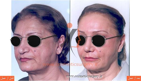 جراحی زیبایی بینی به همراه تزریق چربی