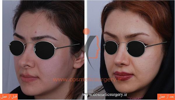 ترمیم بینی در بیماری که قبلا توسط جراحان دیگری عمل شده است
