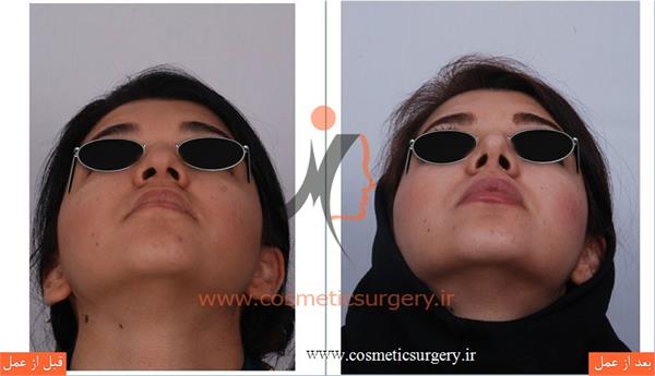 جراحی زیبایی بینی