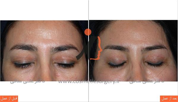 Chin surgery eyebrow lift