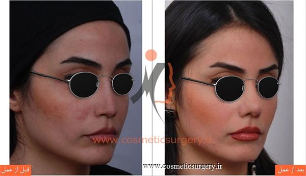 ترمیم بینی عمل شده توسط جراحان دیگر با استفاده از پیوند غضروف دنده