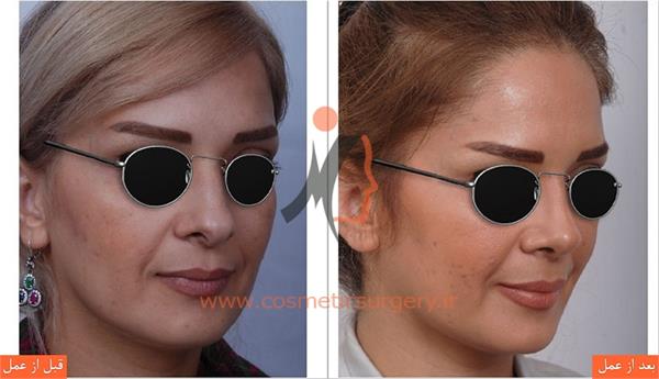 جراحی زیبایی بینی