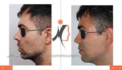 secondary rhinoplasty 2