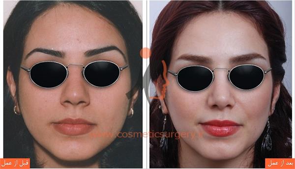 جراحی زیبایی بینی