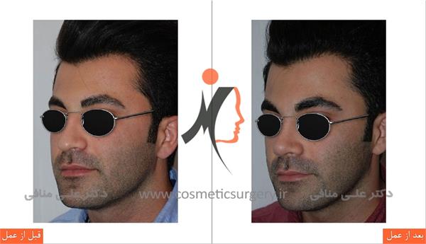 عمل جراحی زیبایی بینی 1