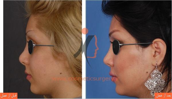 ترمیم بینی عمل شده توسط جراحان دیگر به همراه بلندتر کردن بینی و افزایش تناسب بینی