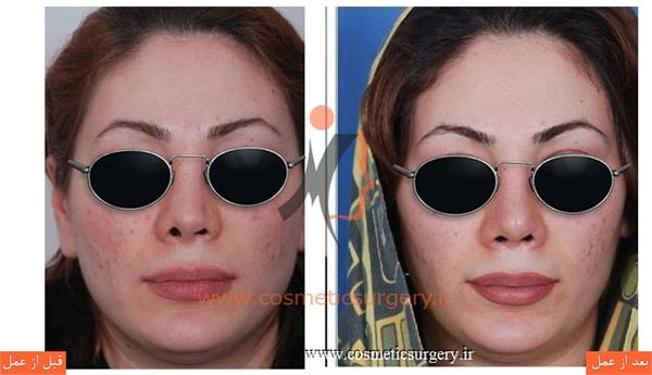 ترمیم بینی در بیماری که قبلا توسط جراحان دیگری عمل شده است