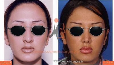 جراحی زیبایی بینی