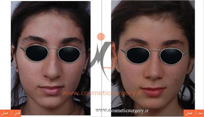 عمل جراحی بینی گوشتی