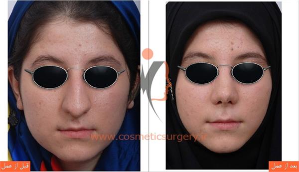 جراحی زیبایی بینی