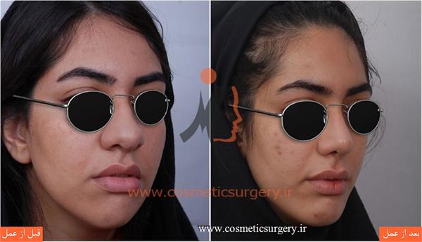 عمل جراحی بینی گوشتی به همراه جراحی چانه