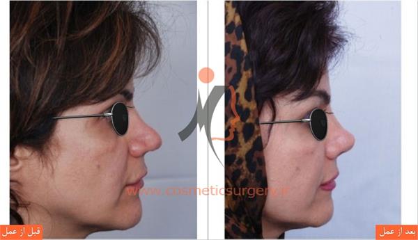 ترمیم بینی در بیماری که قبلا توسط جراحان دیگری عمل شده است