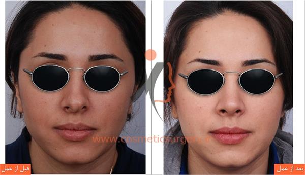 عمل جراحی انحراف بینی