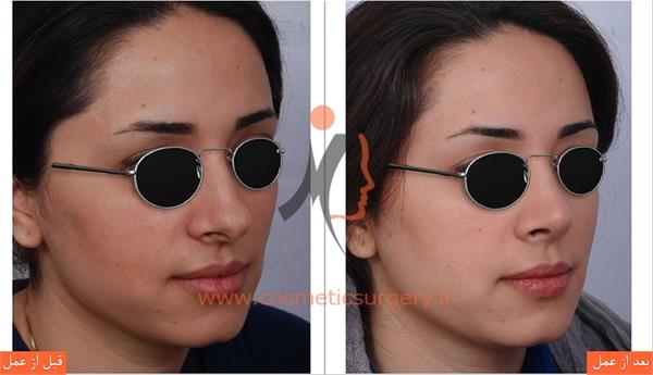 عمل جراحی انحراف بینی