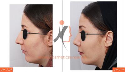 جراحی زیبایی بینی و تزریق چربی 1