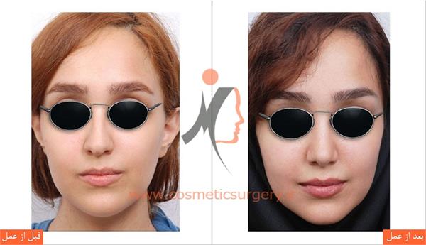 جراحی زیبایی بینی 3