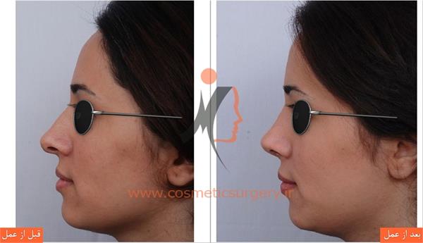 عمل جراحی انحراف بینی