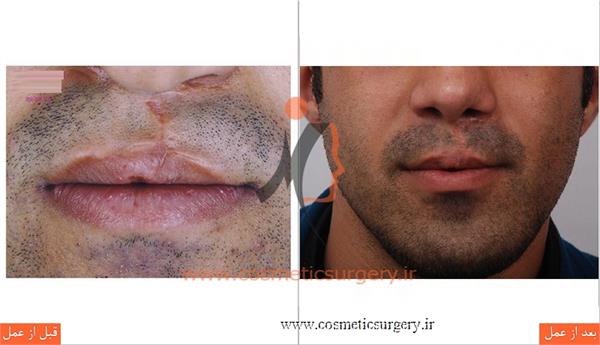 جراحی زیبایی بینی به همراه ترمیم شکاف لب و کام