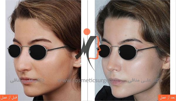 عمل جراحی زیبایی بینی 1