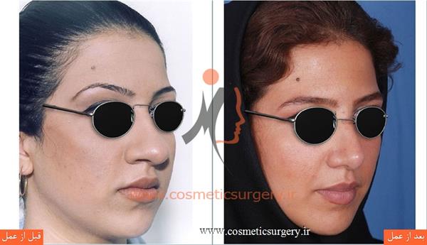 Broiler nose surgery10