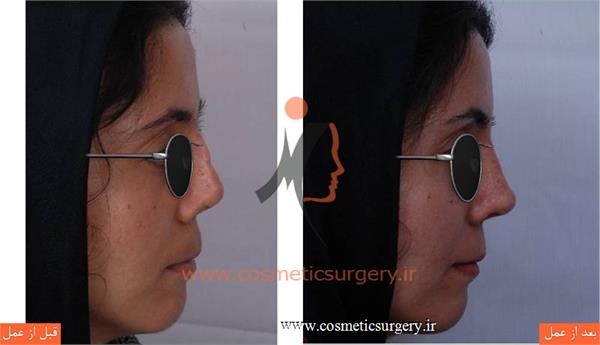 ترمیم بینی در بیماری که قبلا توسط جراحان دیگری عمل شده است