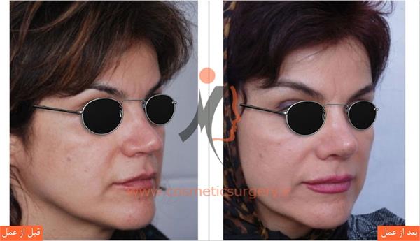 ترمیم بینی در بیماری که قبلا توسط جراحان دیگری عمل شده است