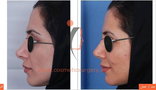 ترمیم بینی به همراه تزریق چربی
