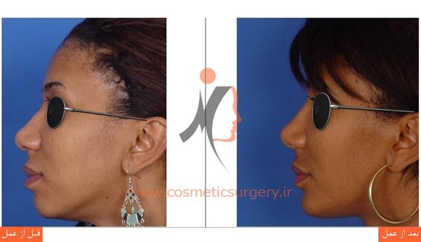 جراحی بینی گوشتی2